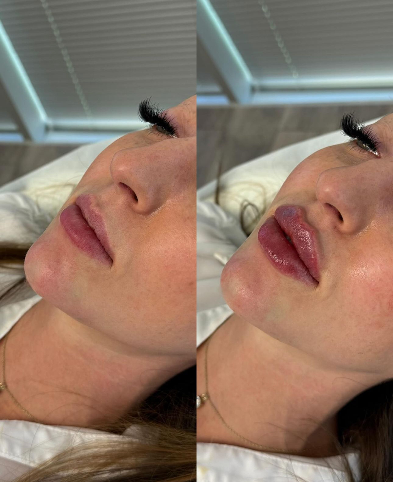 Lip Filler