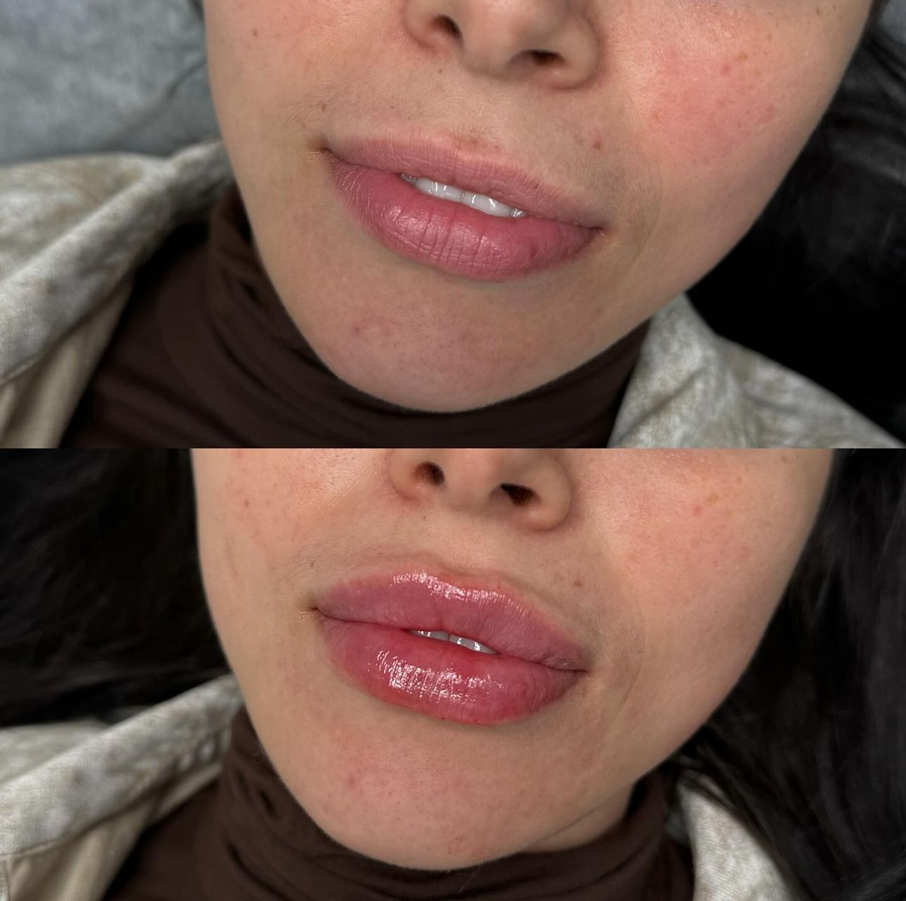 Lip Filler