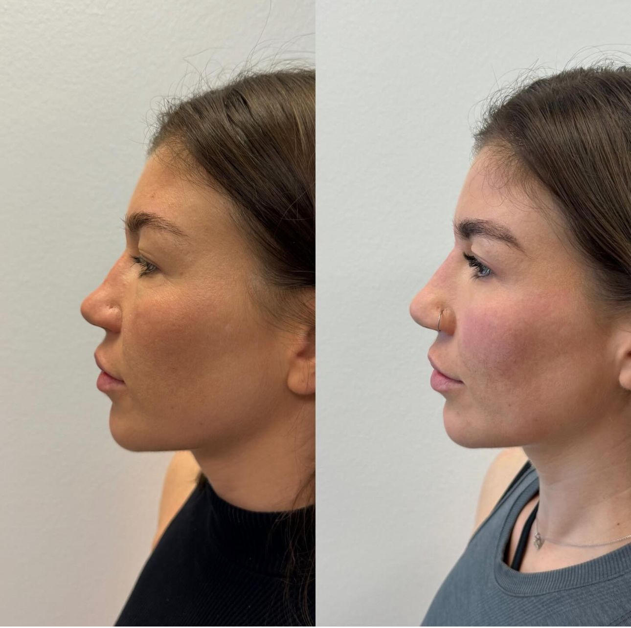 Nose Filler