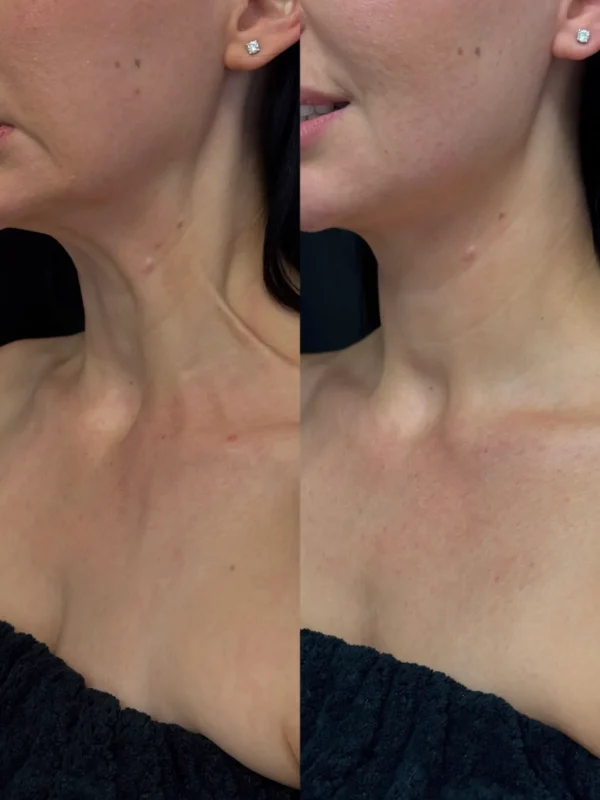 Lower Face & Neck