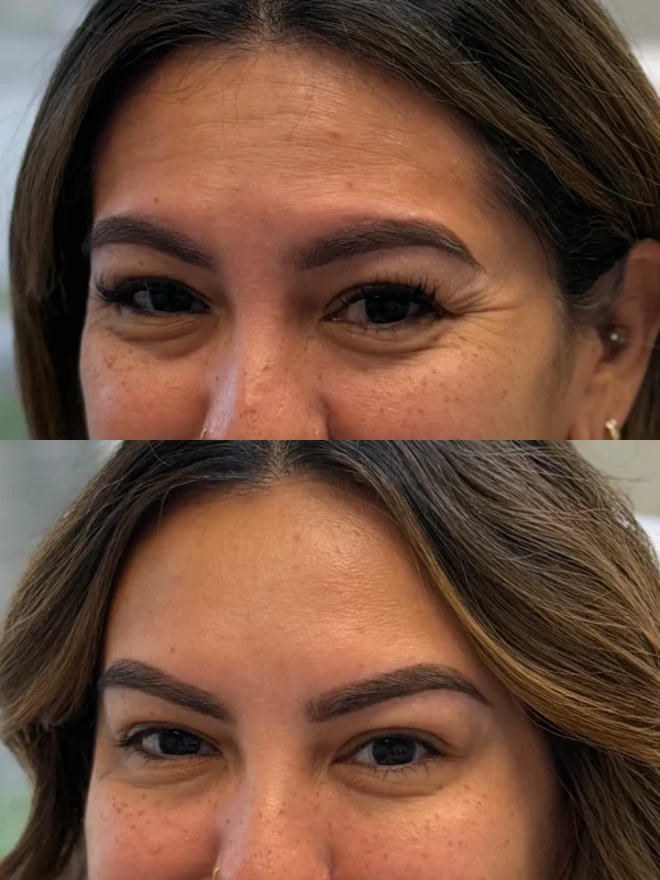 Upper Face & Eyes